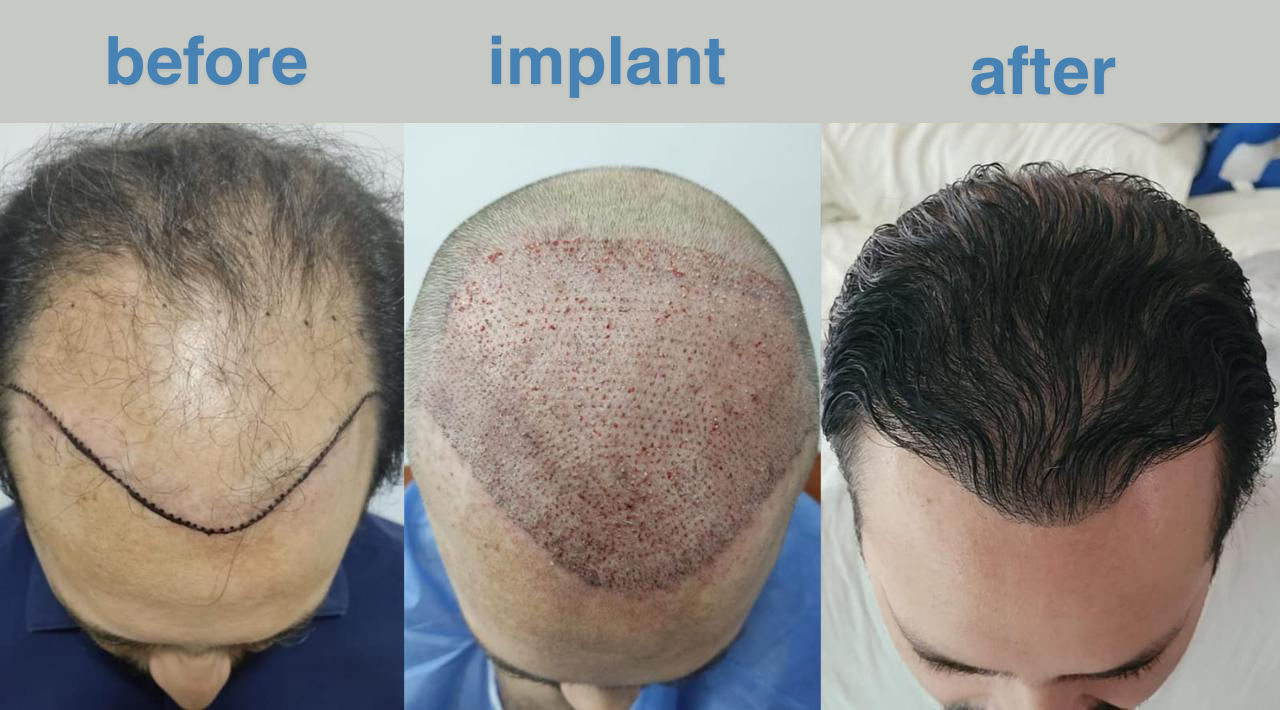 Hair transplant before and after - Tijuana clinic patient results
