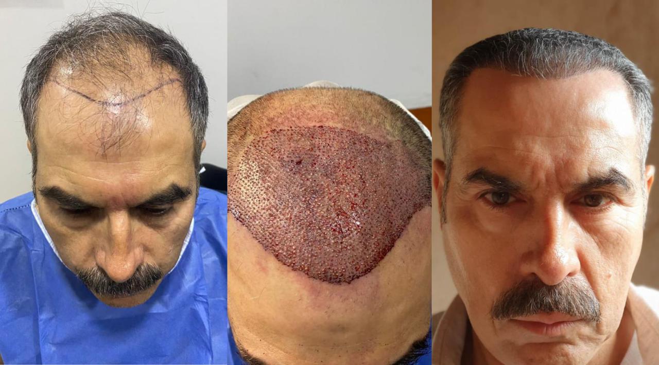 FUE hair restoration results - Natural hairline restoration Tijuana