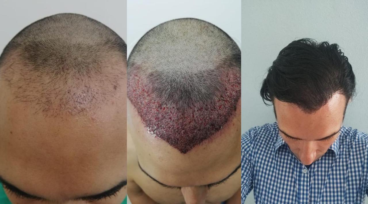 Successful hair transplant outcome - Hair density improvement Mexico