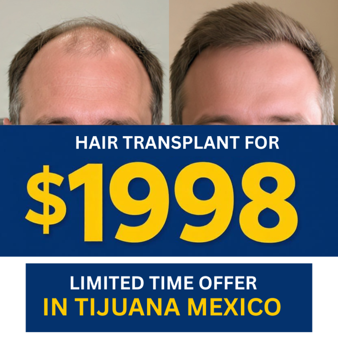 Hair Transplant in Tijuana For Under Two Thousand Dollars